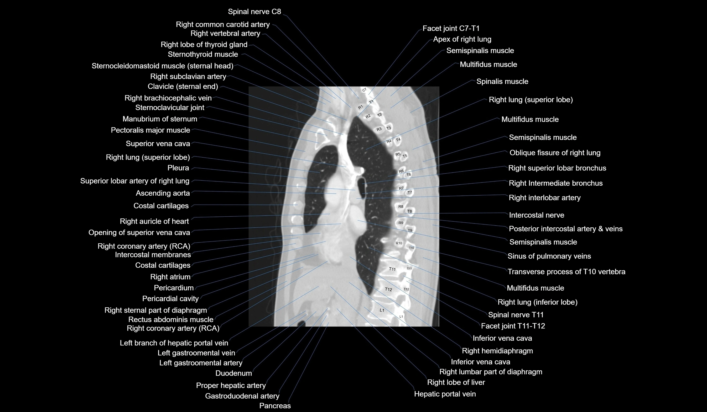CT chest (thorax) labelled sagittal cross sectional anatomy radiology image-00066.webp